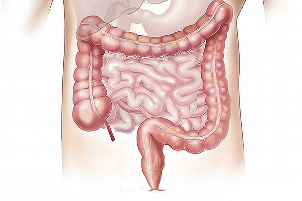 Un dúo bacteriano potencia la inflamación del colon y el riesgo de cáncer