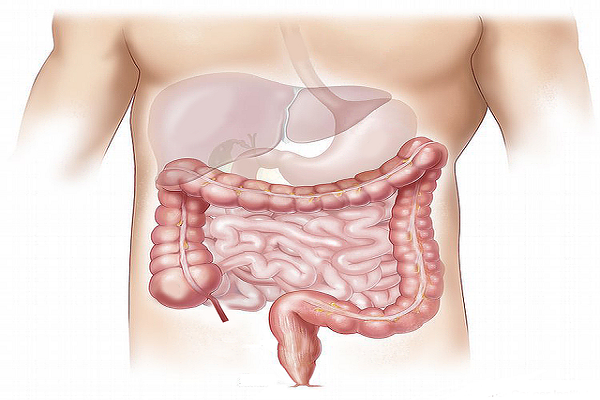 ¿Qué es el cáncer de colon?